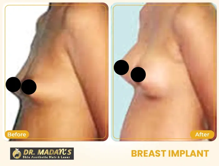 Breast implant before and after result 1 at Dr Madan Aesthetics